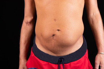 A man's body after kidney transplant surgery, with a fistula on his arm from hemodialysis.