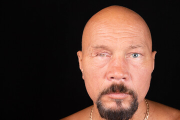 Portrait of a man with a cosmetic eye prosthesis. The consequences of glaucoma. Selective focus.