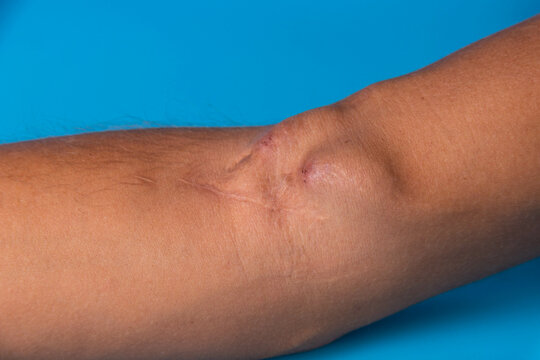 Fistula on the arm as a result of an operation for hemodialysis with kidney failure.