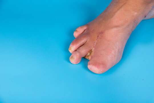 Amputation of diabetic toes of a person on a blue background. Selective focus.