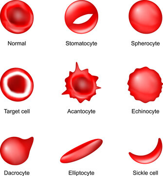 Shape of red blood cell. Sickle cell, Echinocyte, Spherocyte, Elliptocyte, Acantocyte, Stomatocyte, Dacrocyte, Target cell and Normal Erythrocyte. Poikilocytosis. Blood diseases. Vector illustration