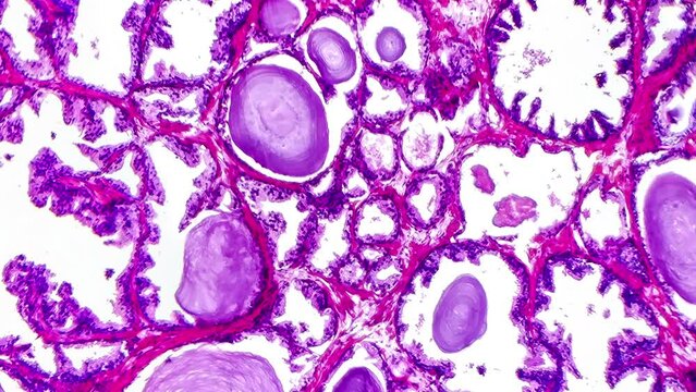 Benign prostatic hyperplasia, light micrograph footage revealing dilated glands and papillary projections inside the glands lumen.