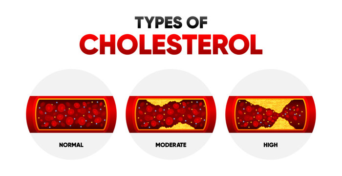 Types Cholesterol. LDL and HDl level. Arteriosclerosis, infarct, ischemia, thrombosis disease. Cholesterol in human blood vessels. Vector illustration.