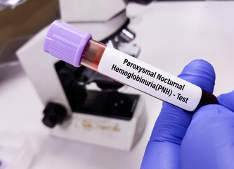 Blood sample for Paroxysmal nocturnal hemoglobinuria (PNH) disease test. HAM'S Test.