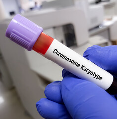 Blood sample for Chromosomal analysis karyotype testing with patient report, study for abnormal...