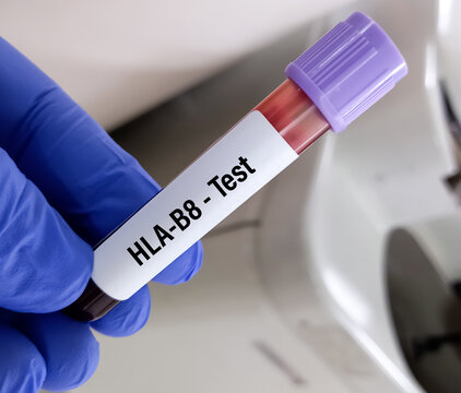 Test tube with blood sample for HLA-B8 (Human Leukocyte Antigen-B8) test.