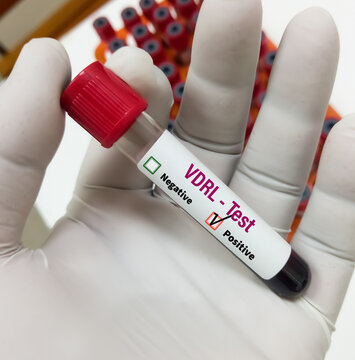 Blood sample for VDRL test, RPR, Syphilis screening test. To diagnosis Syphilis and Gonorrhea, STD disease.