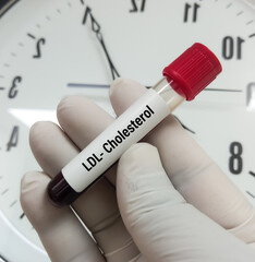 Blood sample for LDL cholesterol test, (Fasting Lipid Profile), total cholesterol, tg, hdl, ldl to...