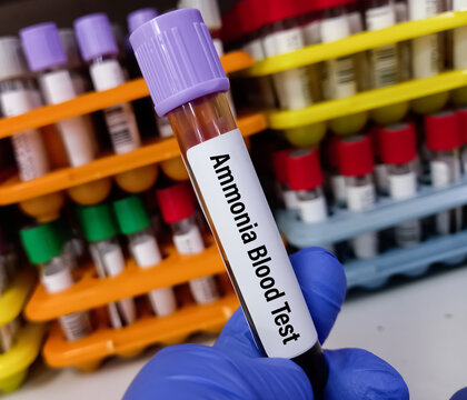 Blood sample for Ammonia test to diagnosis of ammonia levels also known as hyperammonemia. urea cycle deficiencies.