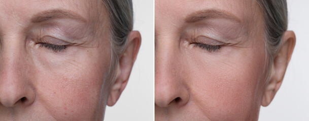 Aging skin changes. Collage with photos of mature woman before and after cosmetic procedure on white background, closeup