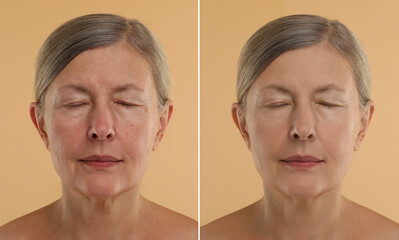 Aging skin changes. Collage with photos of mature woman before and after cosmetic procedure on...