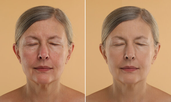Aging skin changes. Collage with photos of mature woman before and after cosmetic procedure on beige background