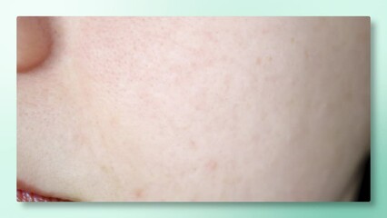 Before and After Skin Care Treatment Frame. A Line Swipes Across the Screen Revealing Clear and Healthy Skin. Skin Care Success Visualisation on a green mint background.