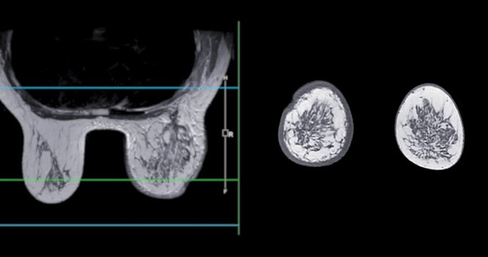 Breast MRI revealing BI-RADS 4 in women indicates suspicious findings warranting further investigation for potential malignancy and  biopsy to confirm the presence of cancerous lesions.