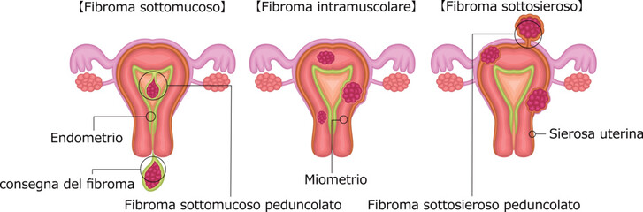 子宮筋腫　分類　イラスト　イタリア語