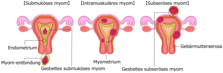 子宮筋腫　分類　イラスト　ドイツ語