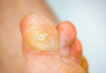 A wart on my toe. HPV plantar wart.