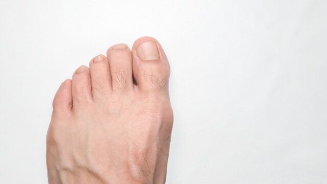 Close up of a person left foot toes with white background and space on the right for text