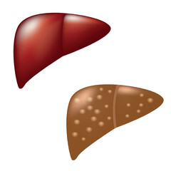 Healthy liver, fibrosis and steatosis, vector