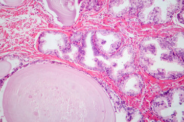 Benign prostatic hyperplasia, light micrograph