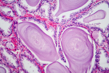 Benign prostatic hyperplasia, light micrograph