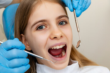 dentist, doctor examines the oral cavity of a little girl, uses a mouth mirror, baby teeth close-up, the concept of pediatric dentistry, dental treatment.