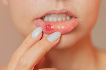A young woman suffering from stomatitis pulls back her lower lip with both fingers, shows an ulcer of stomatitis in the acute stage on the mucous membrane of the mouth. Oral problems - obrazy, fototapety, plakaty