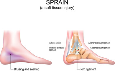 Sprain. A soft tissue injury in the human foot.