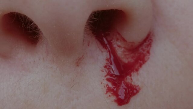 bright red blood flows from nostril, bright red blood flows from nostril, stop bleeding, epistaxis, close-up part of face, fragility of blood vessels, sharp increase in blood pressure