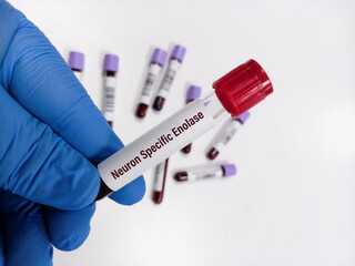 Blood sample for Neuron-specific Enolase (NSE) test, marker for small cell lung cancer. Neuroendocrine tumors (NETs).
