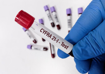 Blood sample for CYFRA-21-1 test, biologic marker of non-small cell lung cancer. cytokeratin 19 fragment test.