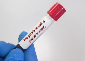Blood sample for proGRP (Pro-Gastrin-releasing peptide) test, marker for small cell lung cancer.