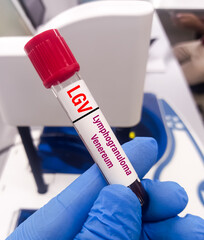 Blood sample for Lymphogranuloma Venereum (LGV) disease diagnosis test. LGV is a sexually...