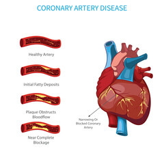 In Coronary artery disease, Narrowing of coronary arteries, leading to reduced blood flow to the heart, potentially causing heart attacks.