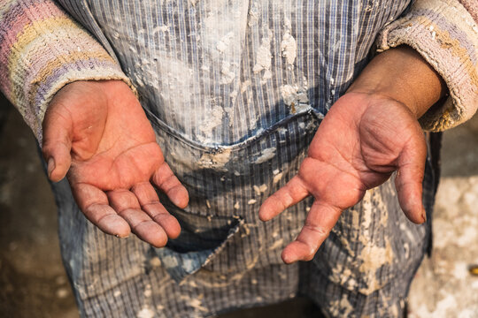 hands of a working woman who lost fingers - concept of disability