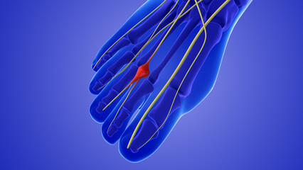 Medical animation of a neuroma or pinched nerve - obrazy, fototapety, plakaty