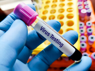 Blood sample for Virus testing at medical laboratory.