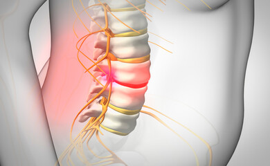 Spinal disc herniation, illustration