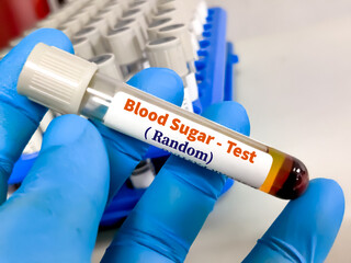 Blood sample for blood sugar levels test. To diagnosis Diabetics Mellitus and insipidus.