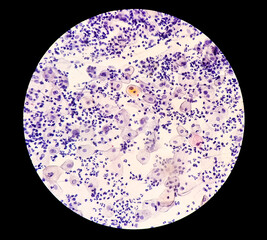 Paps smear: Inflammatory smear with HPV related changes. Cervical cancer. SCC