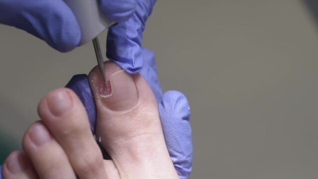 The podologist scrapes the nail with a buffing attachment