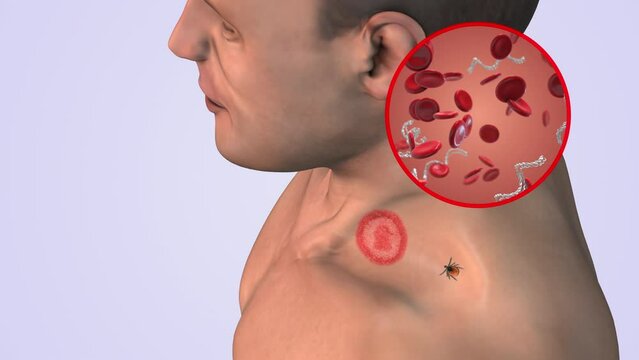 CDC in blood cells with lyme disease on neck
