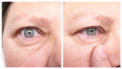 close-up part face middle-aged woman in two versions, eye, revealing natural signs aging such...
