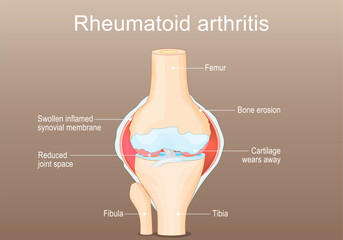 Rheumatoid Arthritis. RA of a knee joint