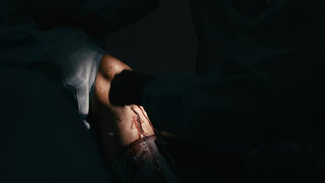 Close-up of professional surgeons performing an operation. During the operation, doctors use modern surgical instruments and equipment. Medical staff working in a hospital operating room.