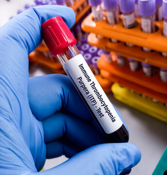 Blood sample for Immune Thrombocytopenic Purpura (ITP) test, idiopathic thrombocytopenic purpura. Thrombocytopenic Disorders, CBC.