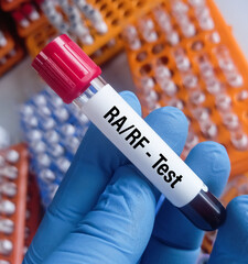 Blood sample RA or RF test, to diagnosis of Rheumatoid factor. Rheumatoid arthritis.