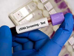 Blood sample for Prenatal cfDNA (Cell-Free DNA) Screening test for pregnant women. Down syndrome. Disorder of the chromosomes.