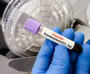 Blood sample for Essential Thrombocythemia (ET) Test, chronic blood cancer (myeloproliferative...