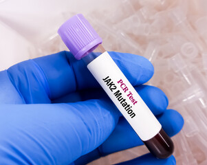 Blood sample for JAK2 (Janus kinase 2) mutation PCR test, to diagnose bone marrow disorders. These...